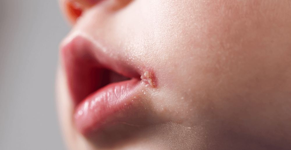 Cold Sore Vs Pimple: How To Prevent, Treat, And Tell The, 43% OFF