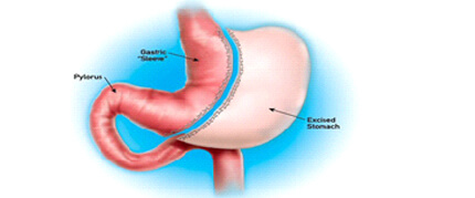 Laparoscopic Vertical Sleeve Gastrectomy Diagram